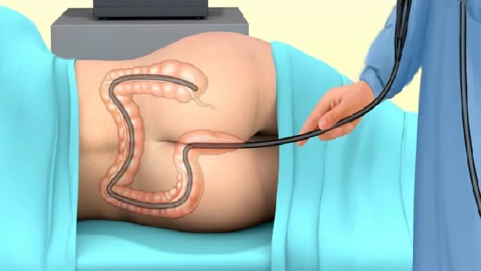 روش های تشخیص سرطان روده