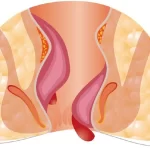 هماتول مقعدی