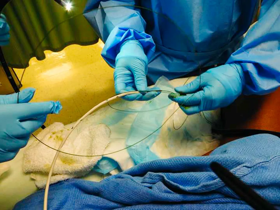 ویدئو جراحی انسداد سیگموئید