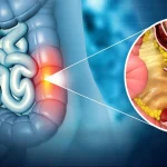 جراحی پولیپ روده (پلیپکتومی روده بزرگ)