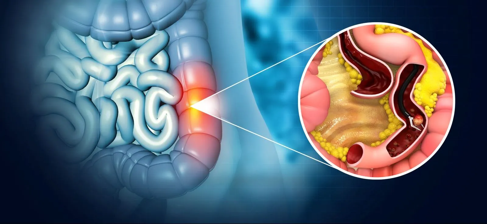 جراحی پولیپ روده (پلیپکتومی روده بزرگ)